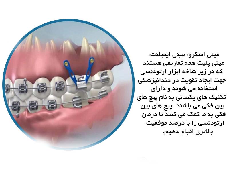 مینی اسکرو ارتودنسی