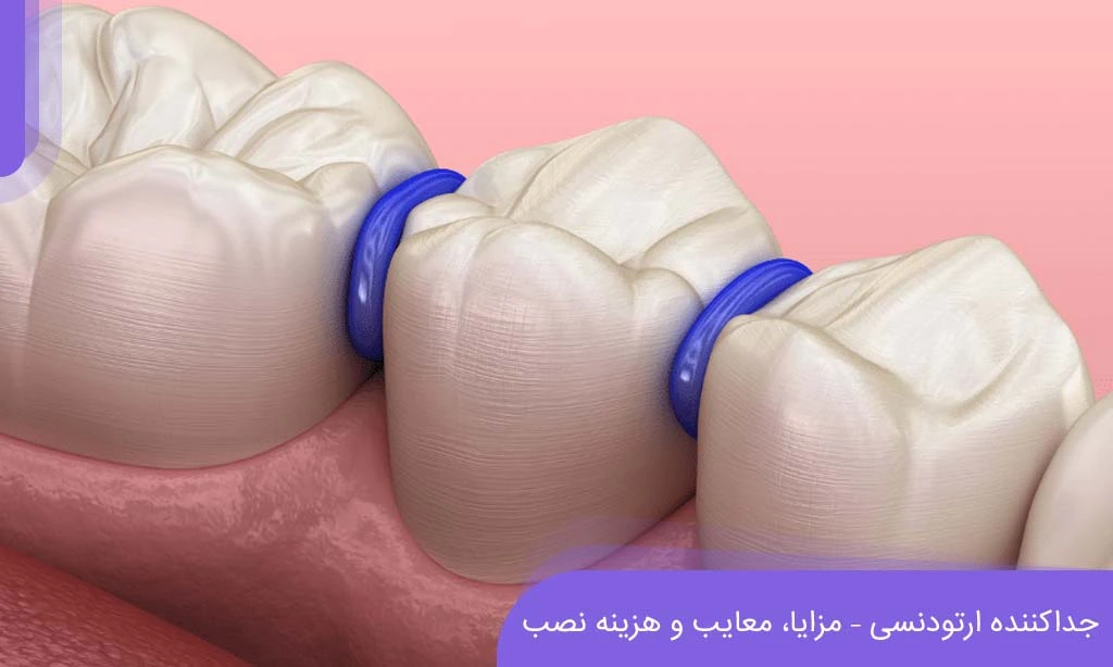 سپریتور ارتودنسی چیست و چه کاربردی دارد ؟