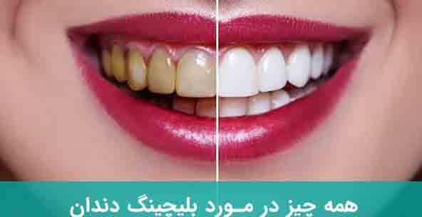 آشنایی کامل با انواع بلیچینگ و روش های موثر برای سفید کردن دندان