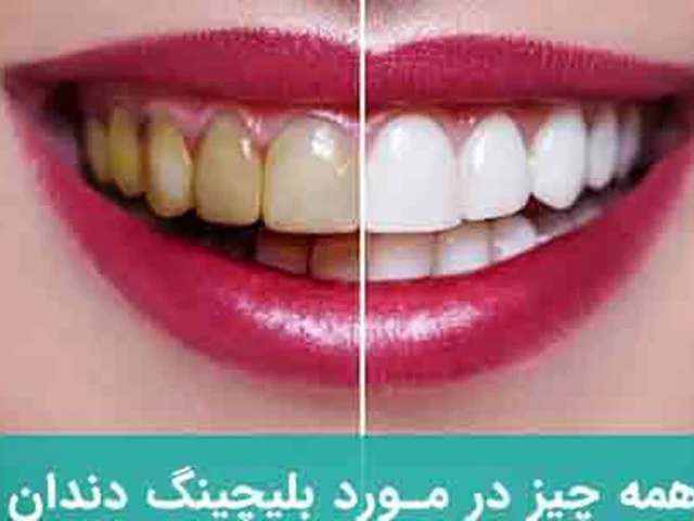 آشنایی کامل با انواع بلیچینگ و روش های موثر برای سفید کردن دندان