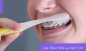 آموزش تصویری مسواک زدن ارتودنسی