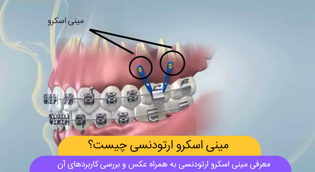مینی اسکرو ارتودنسی و هرچه باید در این رابطه بدانید