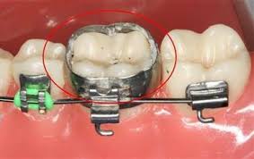 مشکلات مرتبط با بندهای ارتودنسی و راه حل آنها