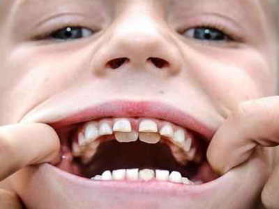 چه زمانی مراجعه و درمان زود هنگام ارتودنسی ضروری است؟