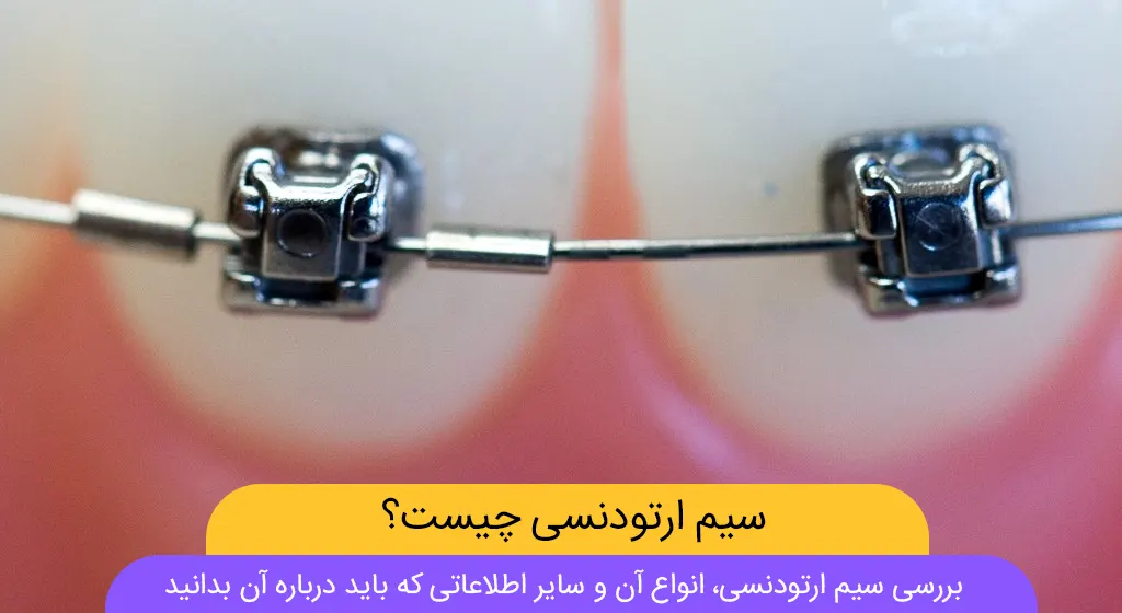 راهنمای جامع حل مشکلات شایع سیم های استیل و NITI  ارتودنسی