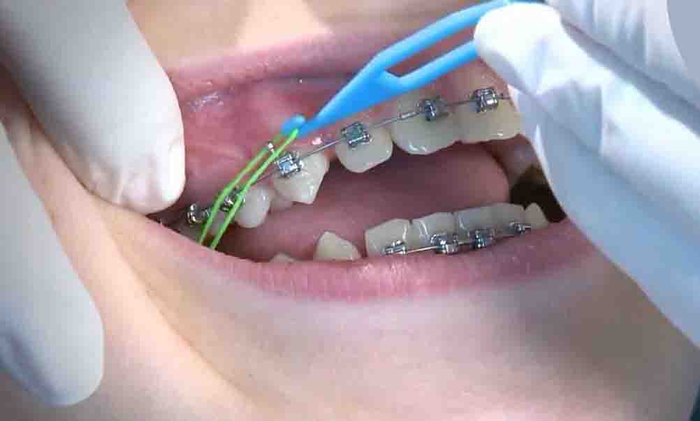 ابزار جا انداختن الاستیک ارتودنسی چیست؟