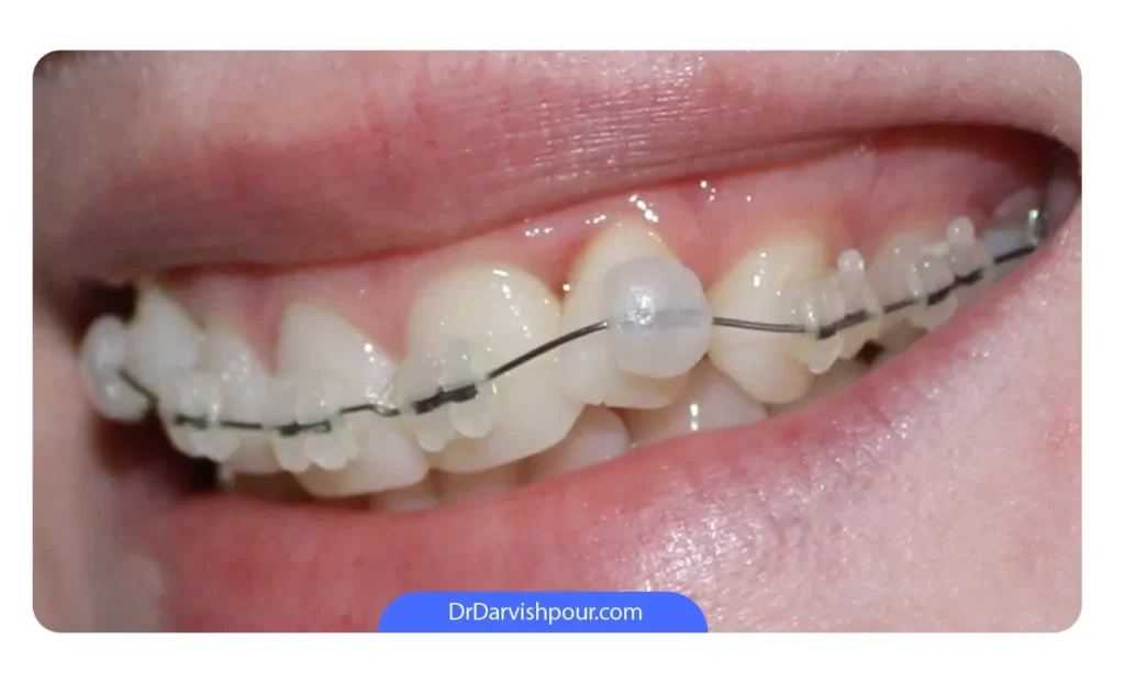 چگونه از موم ارتودنسی استفاده کنیم؟