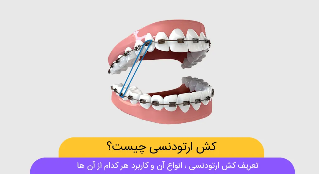 راهنمای جامع الاستیک ارتودنسی